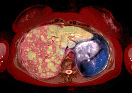 Image: Colored MRI scan of an axial section through the abdomen of a 42-year-old woman with liver cancer (Photo courtesy of Simon Fraser / SPL). Image: Colored MRI scan of an axial section through the abdomen of a 42-year-old woman with liver cancer (Photo courtesy of Simon Fraser / SPL).